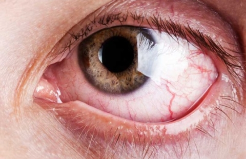 Các bệnh về kết mạc